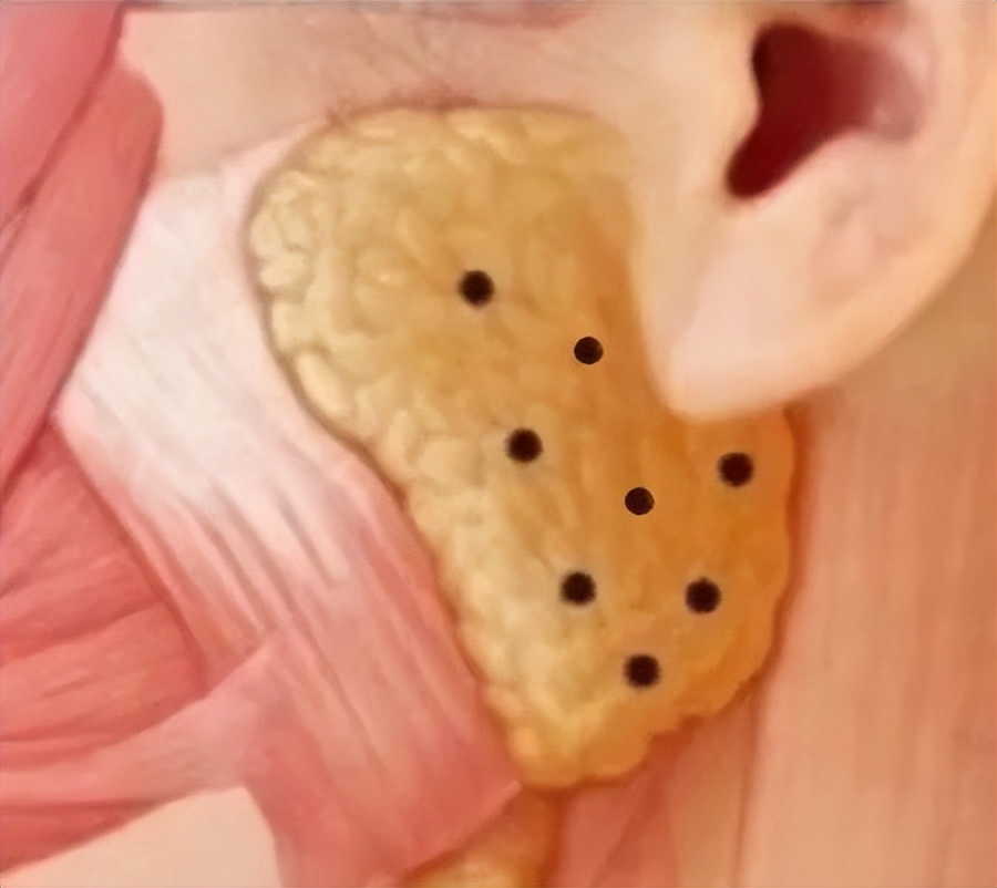 肉毒素打到腮腺,肉毒素可以打腮腺么