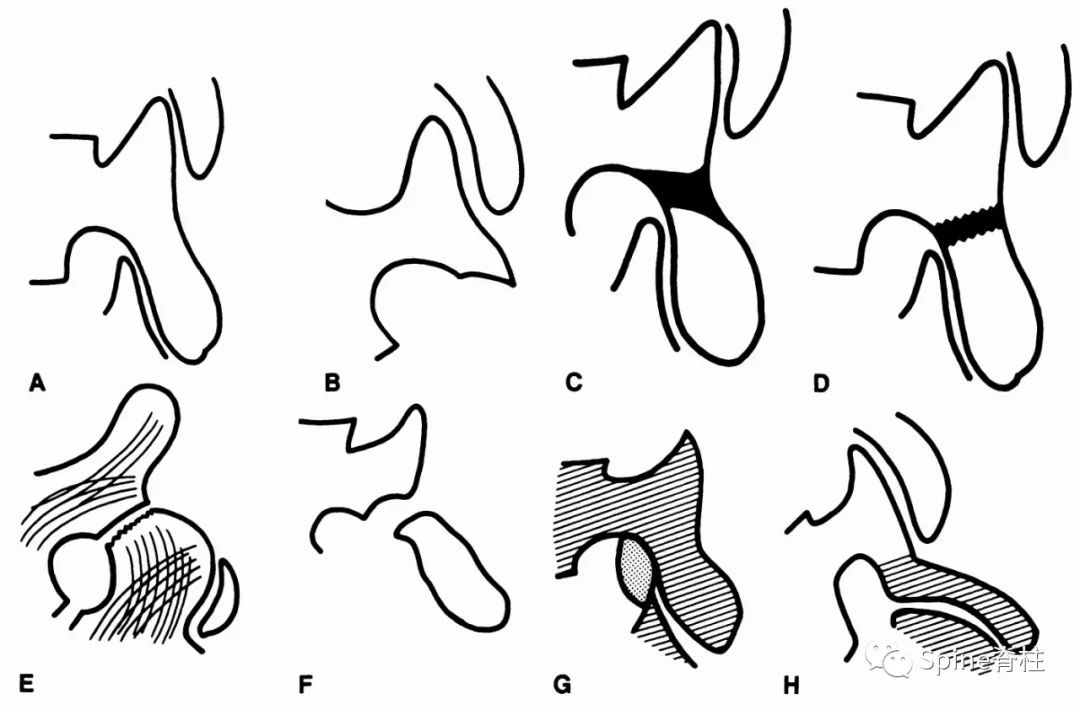 轻度峡部裂和重度峡部裂的区别,真性峡部裂和假性峡部裂