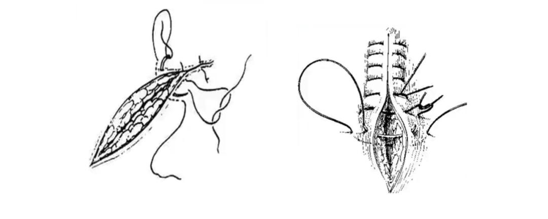 外科缝合技巧你熟练吗,外科缝合术的操作步骤