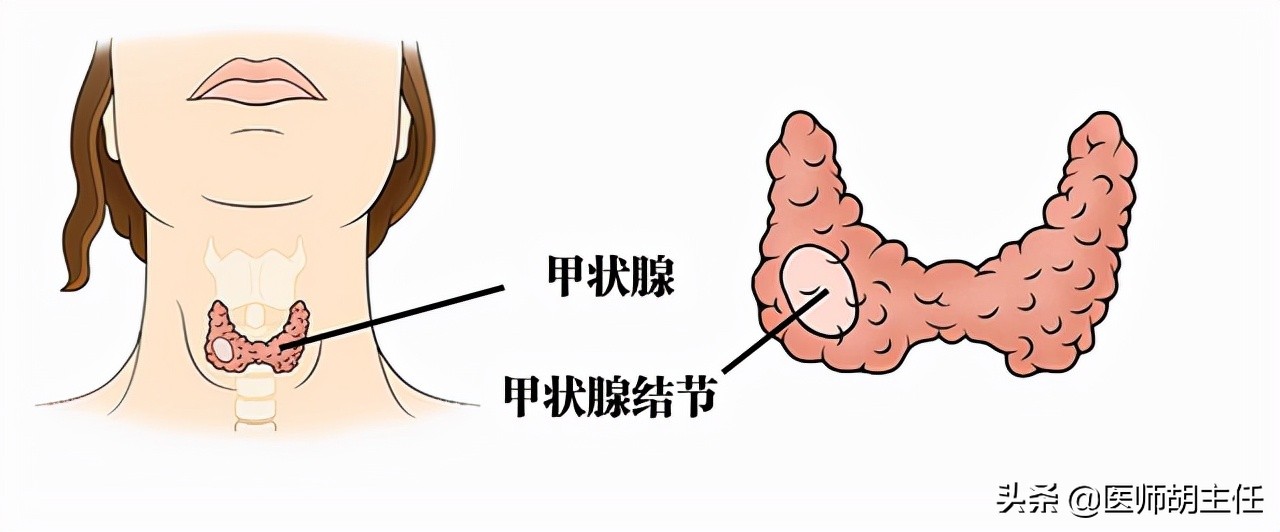 体检查出甲状腺结节到底要不要,体检查出甲状腺结节需要重视吗