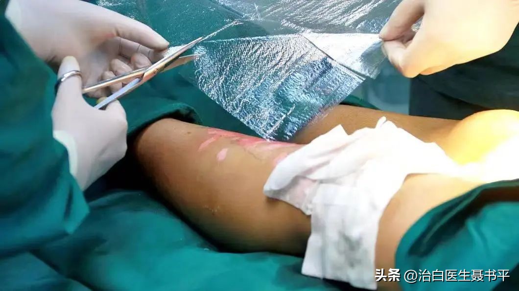 大面积的白癜风怎样才能治愈,大面积白癜风照308贵吗