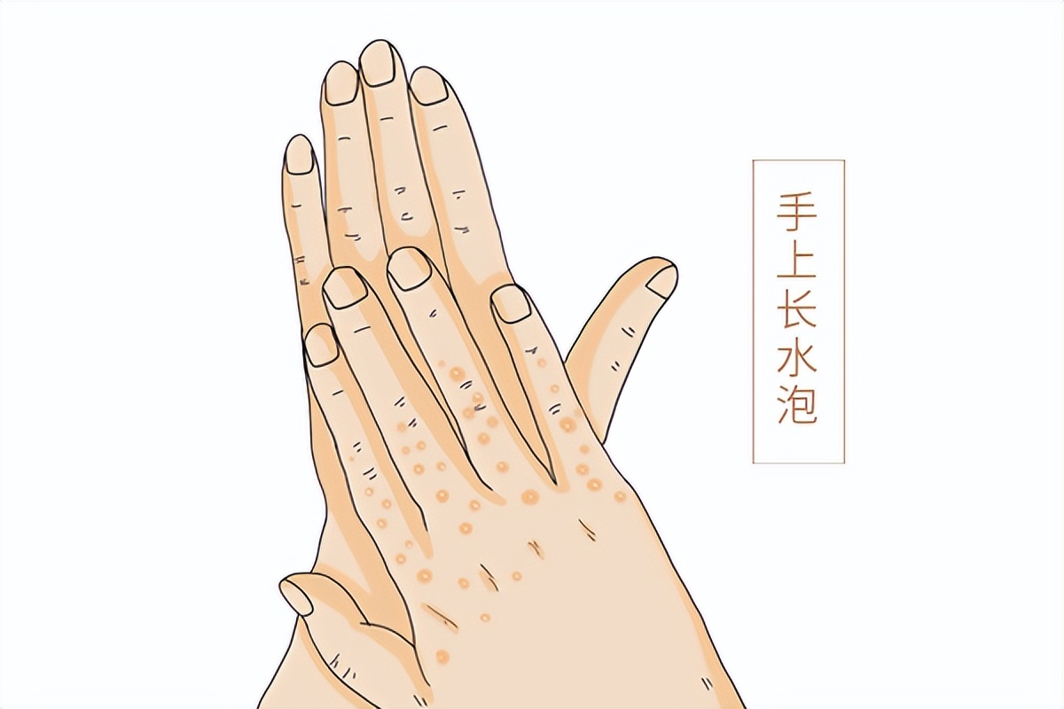 手脱皮的原因和治疗手脱皮方法,手皮肤脱皮的原因和治疗方法