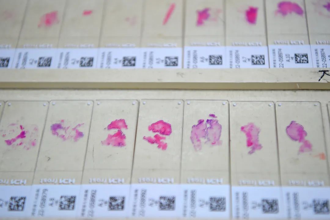 医生说病理报告有点小问题,病理报告没出来好害怕啊