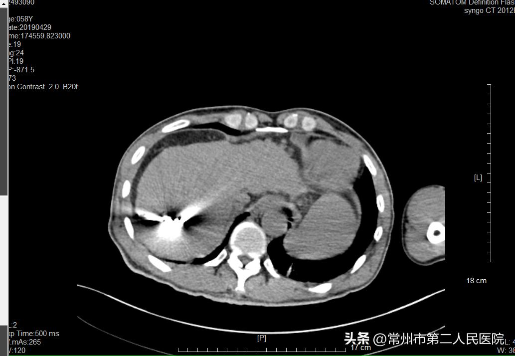 冷冻消融微创手术治肿瘤,精准微创治疗肿瘤