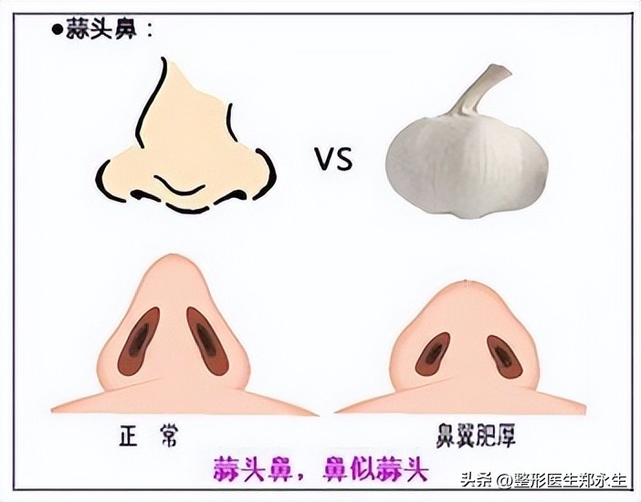 丑鼻子如何变成好看的鼻子,什么样的鼻子让人难看