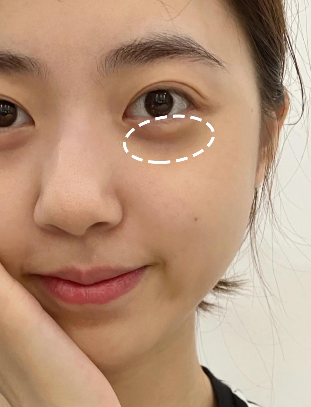 各种黑眼圈最全解决方案,赶紧收藏