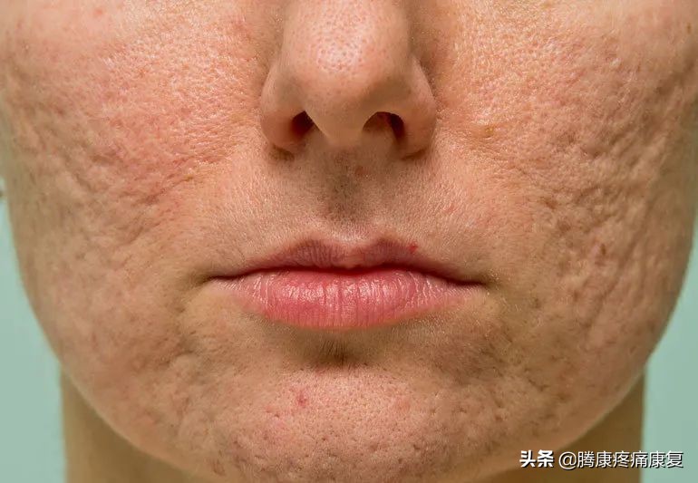 疮疗的后遗症怎么治疗,痤疮留下的瘢痕疙瘩