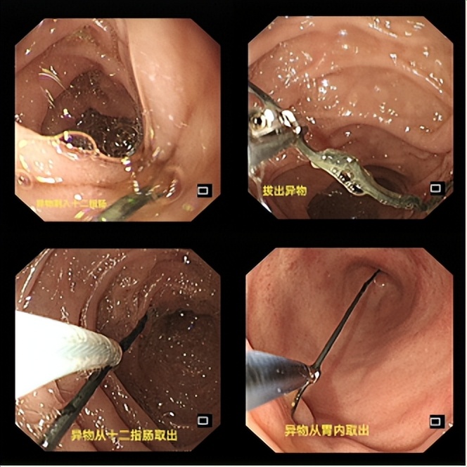 误吞异物成功案例,误吞硬物怎么救