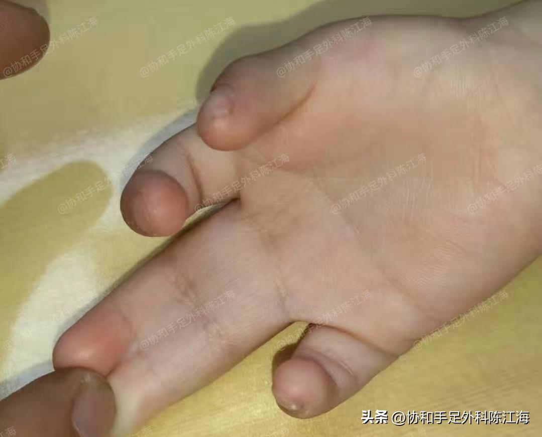 漂浮拇指治愈后样子,漂浮拇指治愈后图片