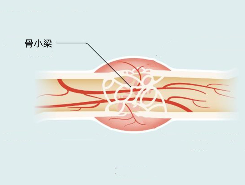 骨折恢复到怎么样就可以穿石膏了,骨折拆石膏后是完全愈合了吗