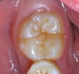 几岁到几岁适合做窝沟封闭,长大了还可以做窝沟封闭吗