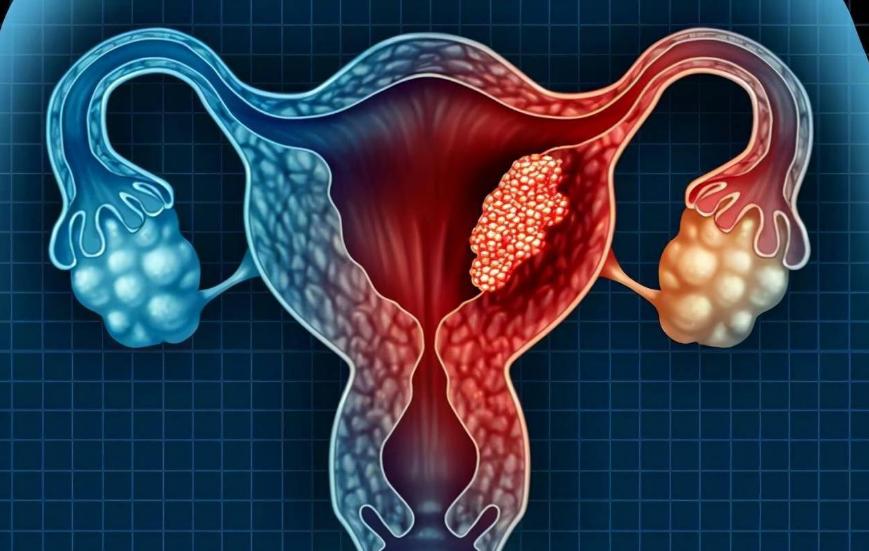 45岁女子确诊宫颈癌,子宫全切,提醒:月经若有这种感觉,别大意