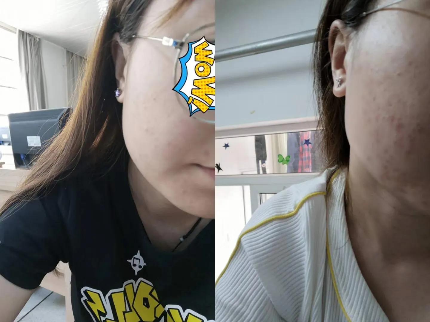 疱疹的中医辨证论治,疮的中医辨证论治