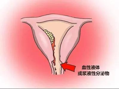 绝经后子宫内膜增厚6.8一定是癌吗,绝经后的子宫内膜癌有哪些症状