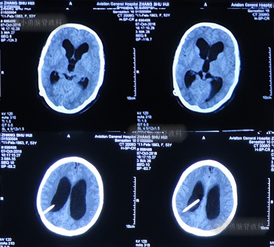 脑积水手术后4天还呕吐怎么回事,脑积水分流术后一直腹部疼痛