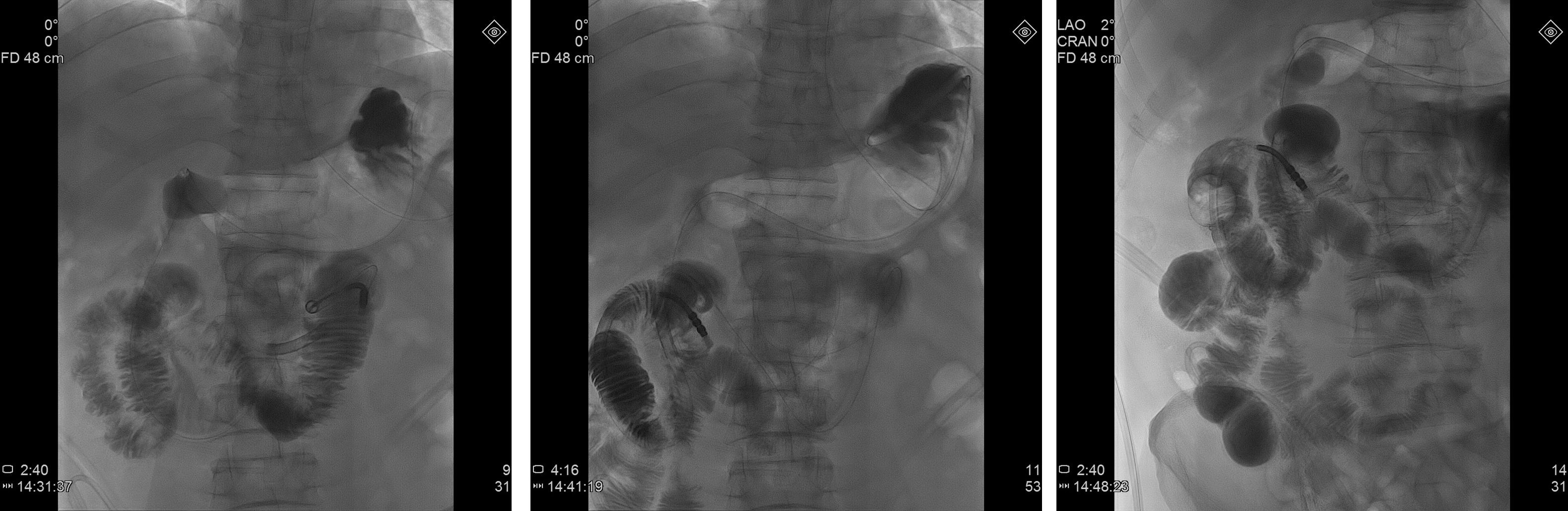 非手术能治疗高位的肠梗阻吗,小肠梗阻的诊断