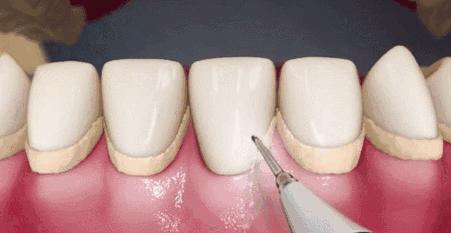 牙齿内部发黄是怎么回事怎么解决,牙齿发黄清洗小妙招