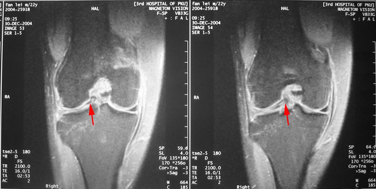 膝关节酸软胀痛、甚至上下楼梯也疼，该怎么办？