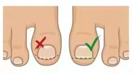 脚趾甲总是往肉里长怎么办,脚趾里长指甲怎么办