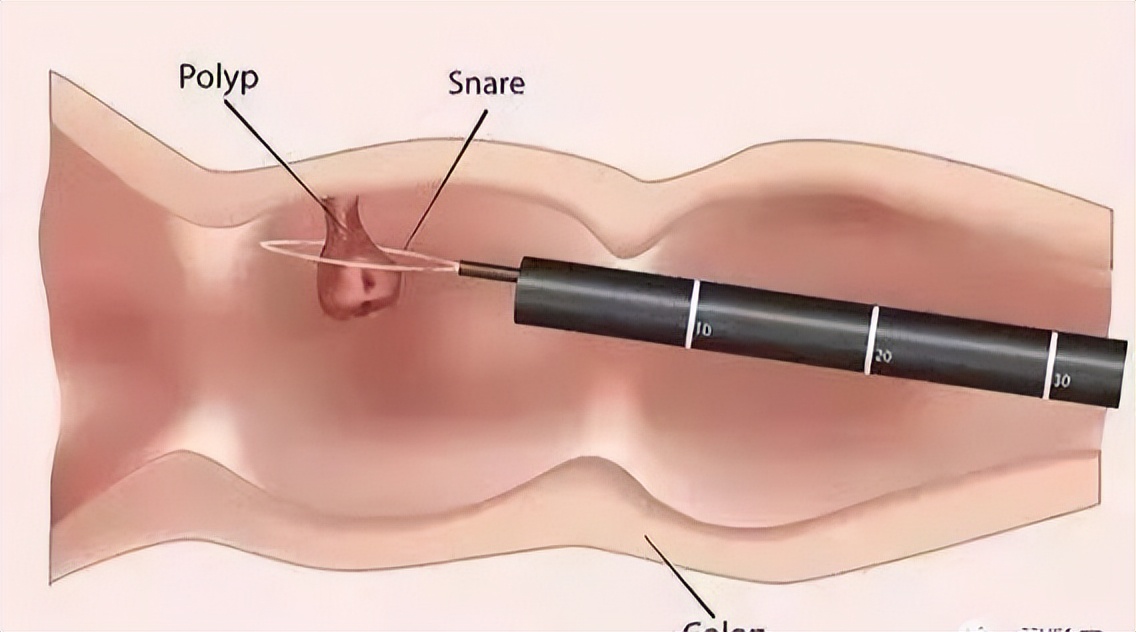 胃肠息肉切除后注意什么,胃肠息肉切除手术后注意事项