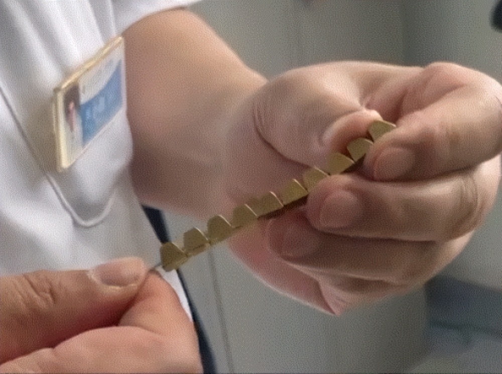 “小磁环”巧解大难题西安交大一附院应用S形磁环治疗直肠狭窄