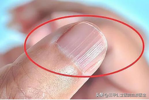 手指甲出现横纹预示身体怎样,手指甲有凹凸竖纹正常生理现象