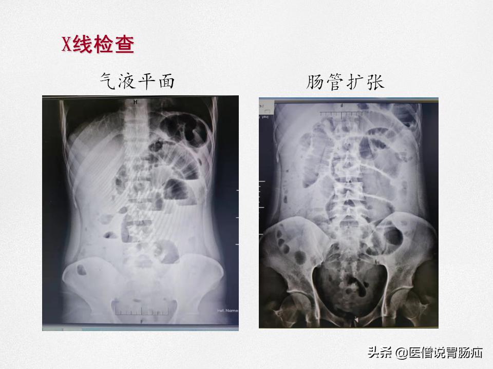 肠梗阻健康教育,肠梗阻患者的健康宣教