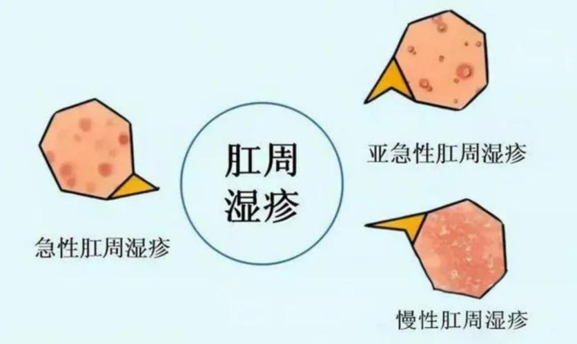 肛周湿疹外用药,肛周湿疹导致皮肤溃烂