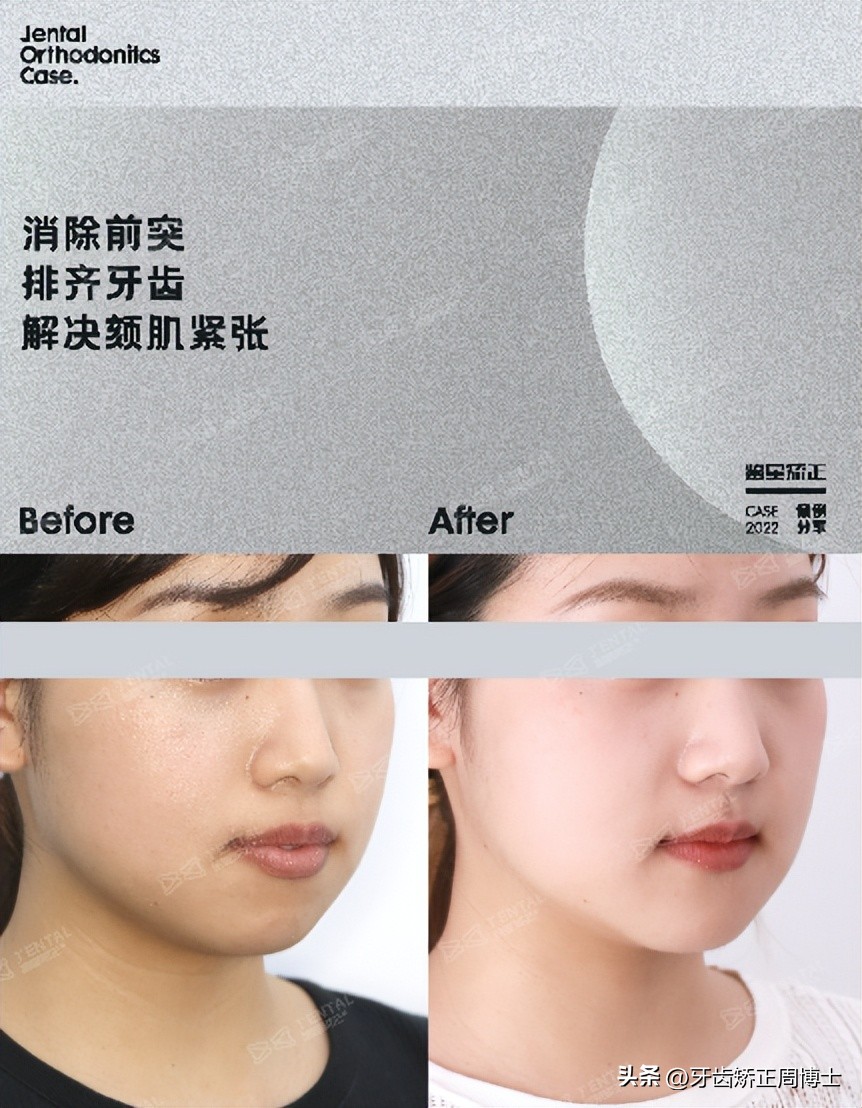 低角面型下巴前倾正畸案例,露龈笑嘴凸下巴后缩