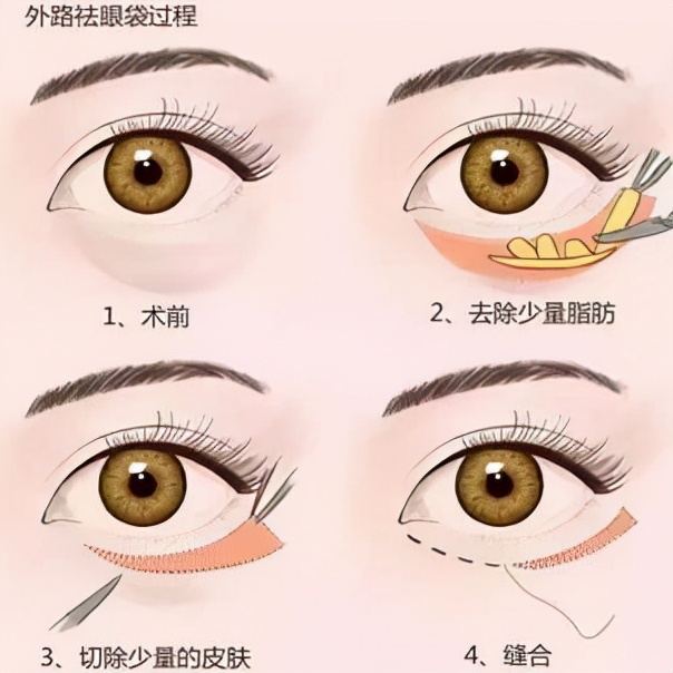 上海第九人民医院不开刀去除眼袋,顽固眼袋别担心不开刀也能变好看