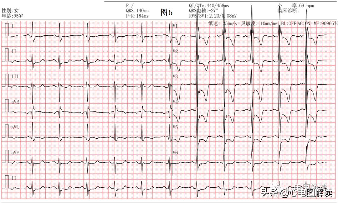 完全性右束支阻滞有什么症状吗,完全性右束支传导阻滞的中成药