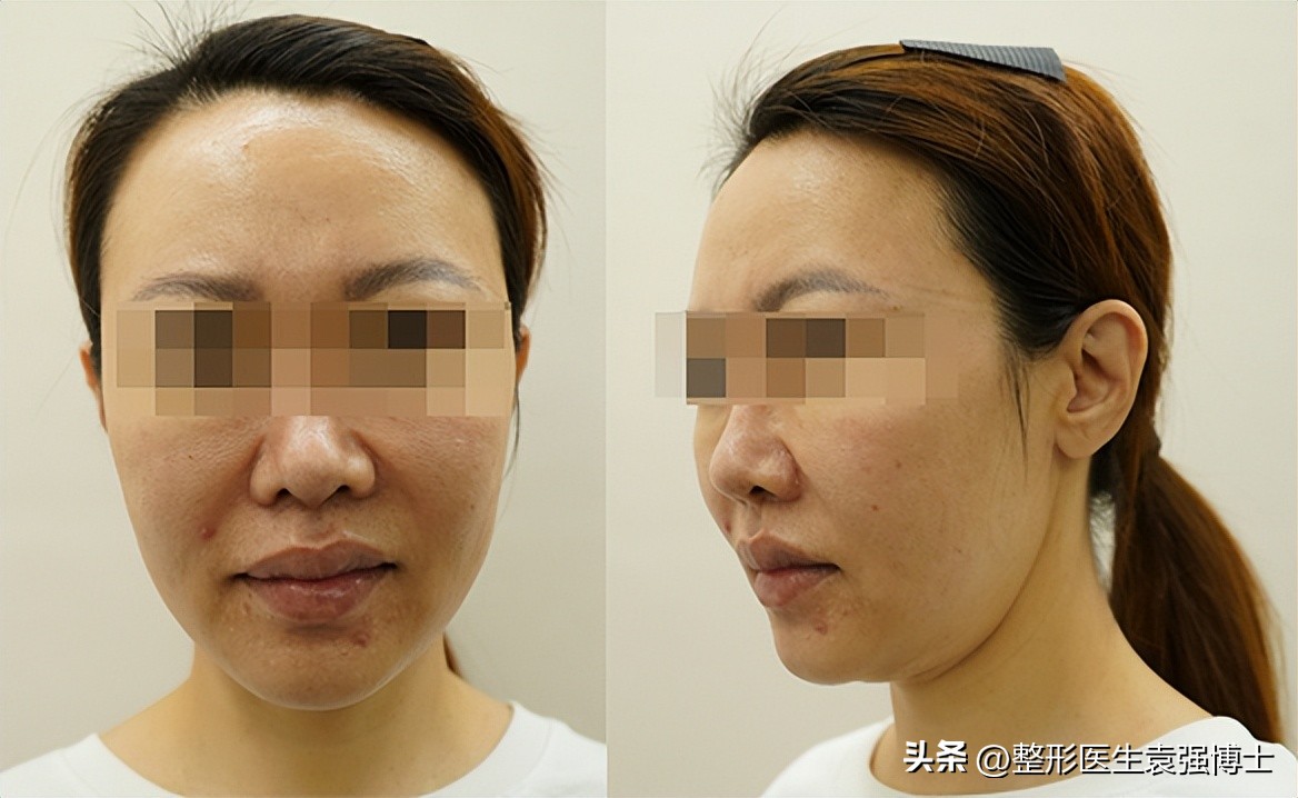 做过面部小拉皮的真实案例,全脸拉皮手术前后的真实对比