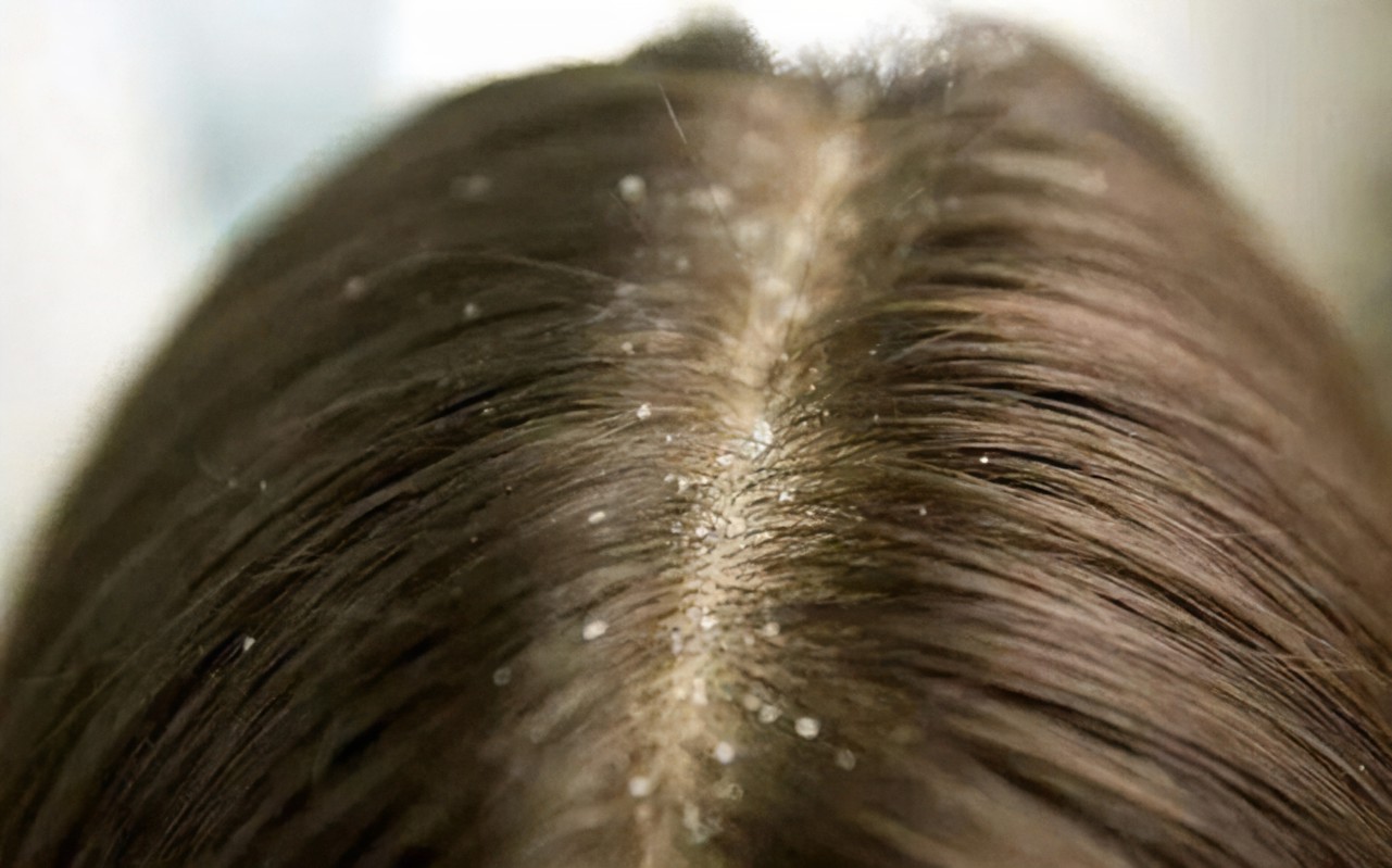 头皮屑很多头皮痒？头皮屑原因解析，3招改善头皮屑问题