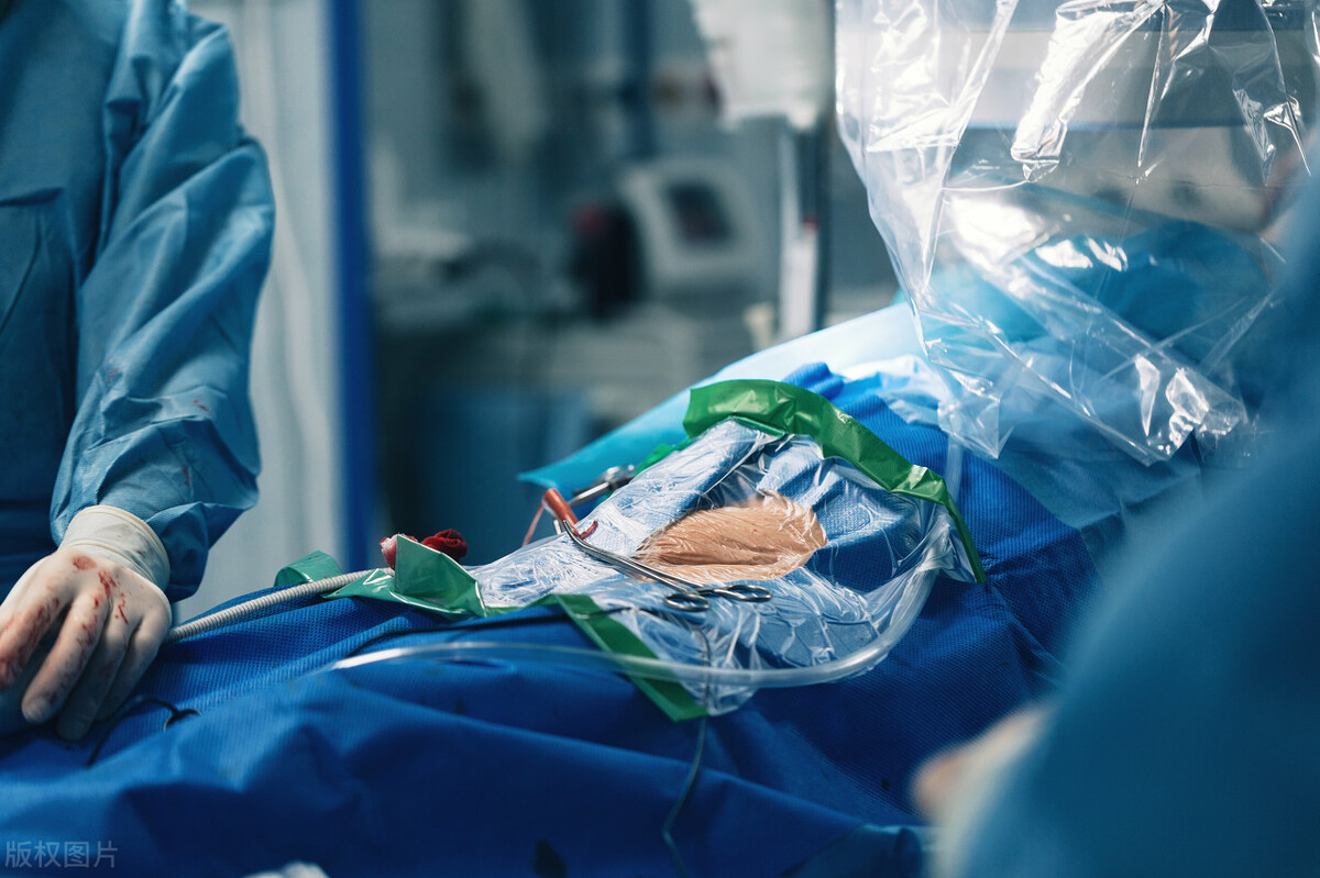 心脏支架从万元时代进入百元时代,心脏支架真的由700涨到30000吗