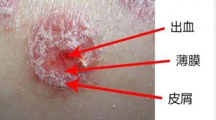 银屑病的急性期应该吃什么中成药,中医治疗银屑病的最好方法