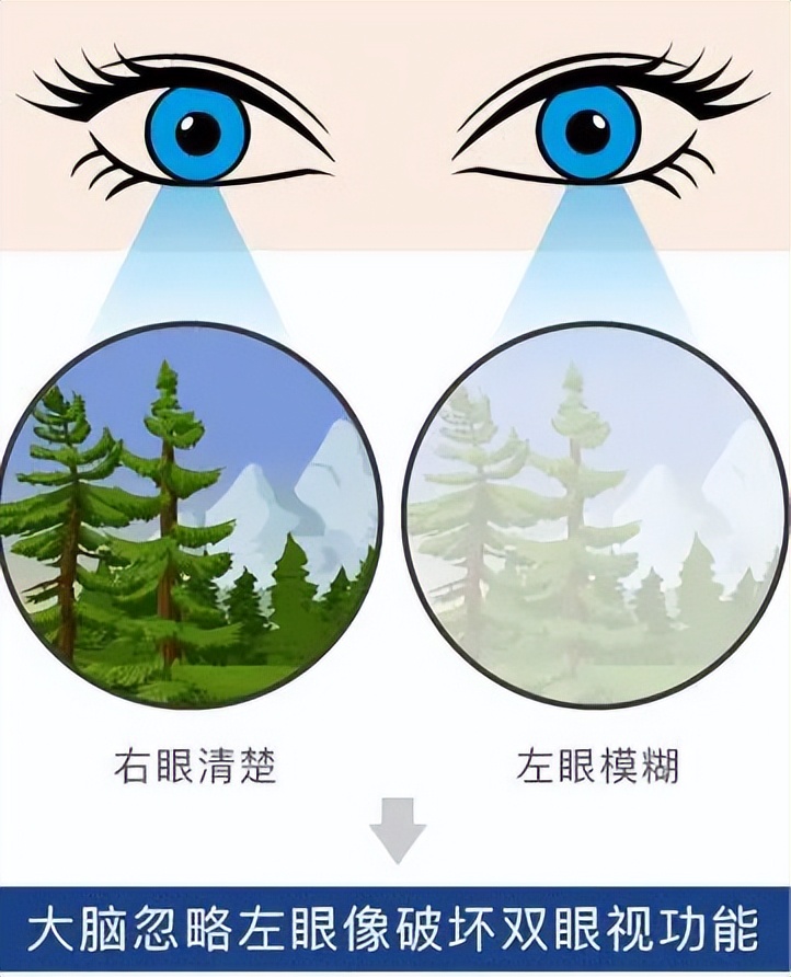 两只眼睛度数相差400多度怎么办,南石眼科医院