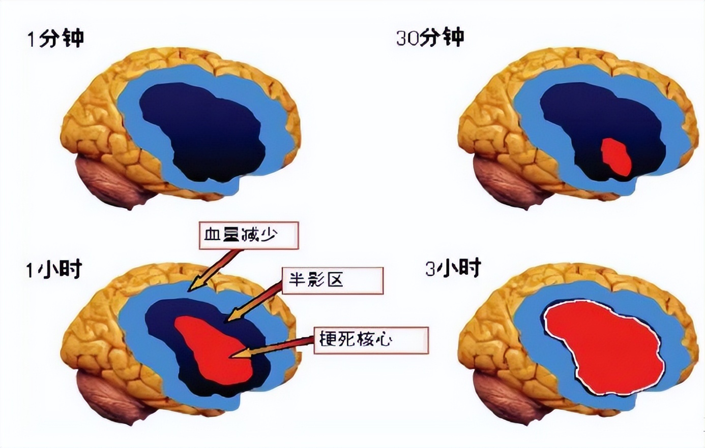 识别卒中早期症状,识别卒中要早一秒