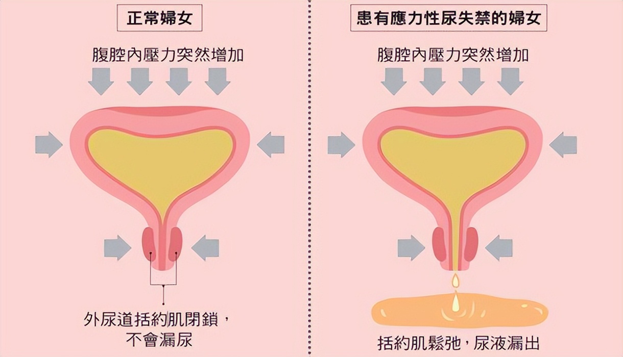 关爱女性关注盆底健康,市人民医院关爱女性健康