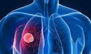 ​广药三院｜肺腺癌局部治疗的重要“利器”之一