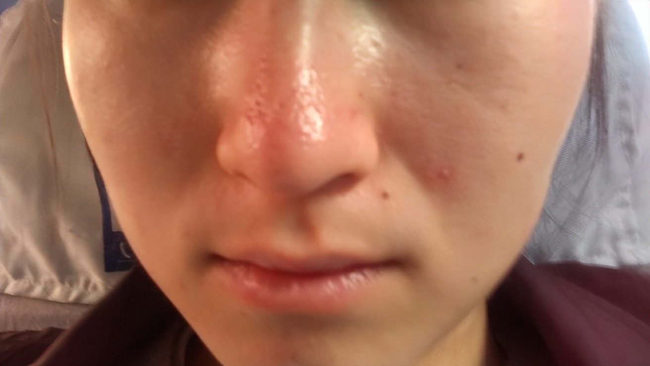 鼻子上挤出油脂粒毛孔怎么收缩,鼻子毛孔的油脂粒怎么去除