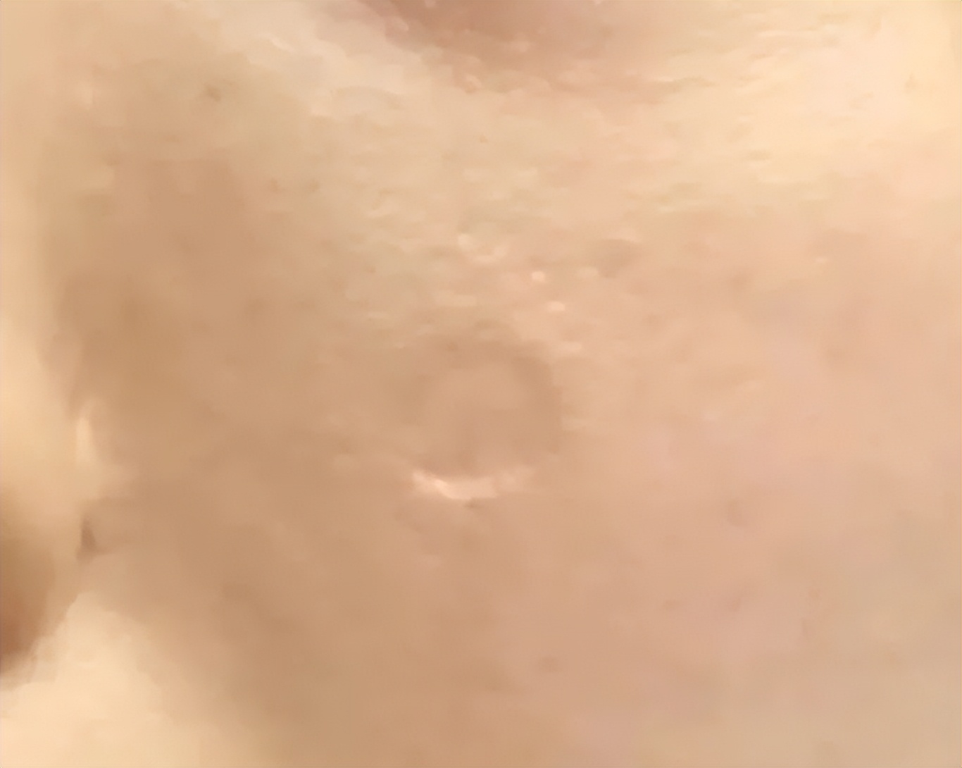 点痣水点痣留疤痕怎么办,如何修复点痣后的凸起疤痕