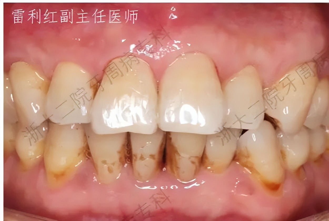 怎么拯救脱发小仙女,如何拯救牙齿上的黑洞