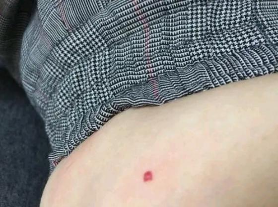 肝硬化身上长小红点痒是什么征兆,肝硬化脚面出了好多小红点有点肿