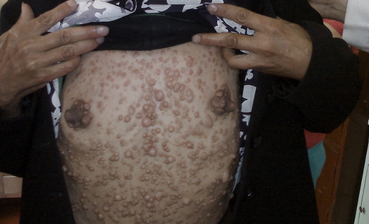 河南22岁女孩体内上千瘤子,22岁女孩体内有1000多个瘤子后续