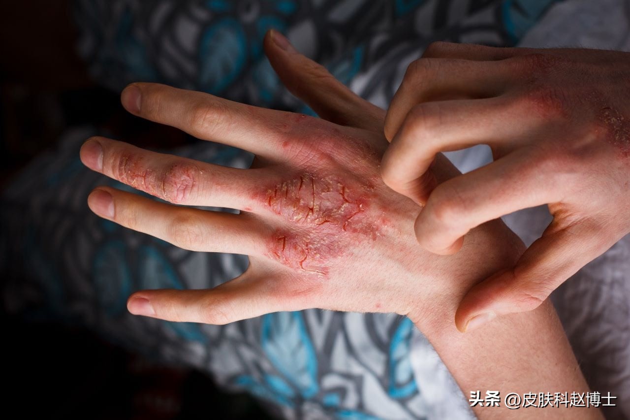 手部湿疹怎么治才能除根,手部湿疹一直不好怎么办