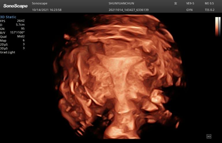 南昌妇幼保健院输卵管无痛造影,子宫输卵管超声造影的检查准备