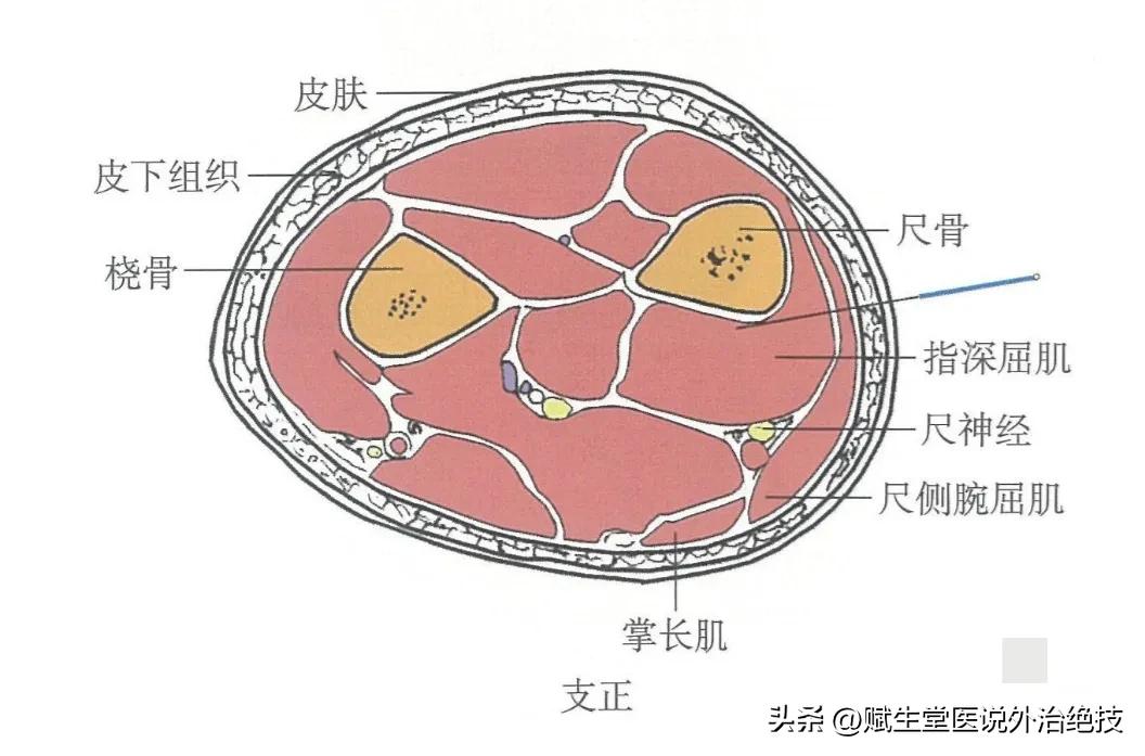 丝状疣中医穴位治疗,赘疣的中医治法