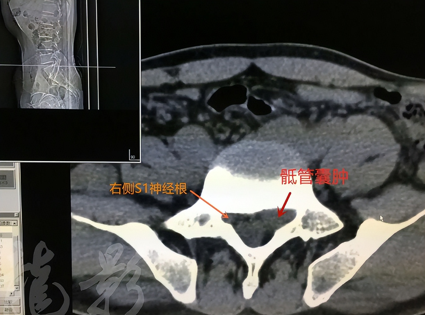 骶管囊肿做什么检查,查出骶管囊肿后尾骨胀