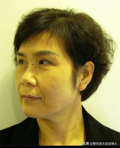 腹部拉皮亲身经历,拉皮去皱亲身经历做小拉皮失败率