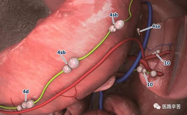 全腹腔镜胃癌根治术，学习大咖怎么清扫淋巴结